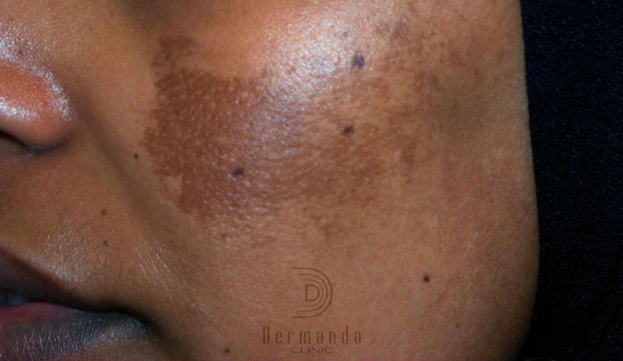 صورة توضيحية - ‏Dermanda Clinic إسم رائد في علاج الكلف بمختلف أنواعه
