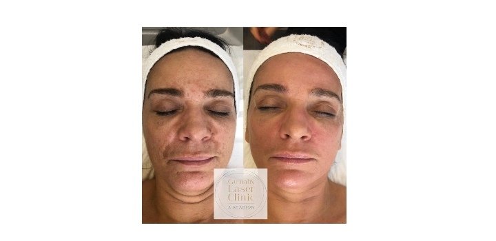 صورة توضيحية - مركز The Carnaby Laser Clinic في لندن إسم رائد في مجال العلاج بالليزر
