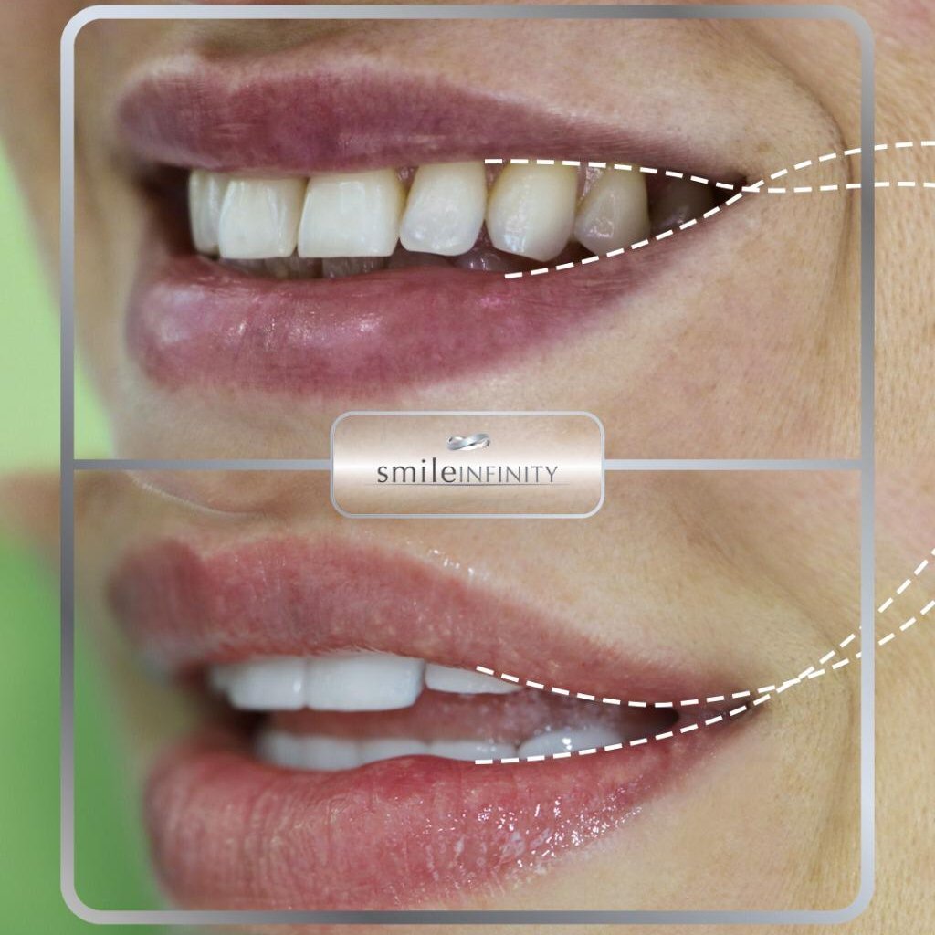 صورة توضيحية - الدكتور حبيب ظريفه يبتكر تقنية جديدة لمحاربة الشيخوخة و تجميل الأسنان Smile Lift