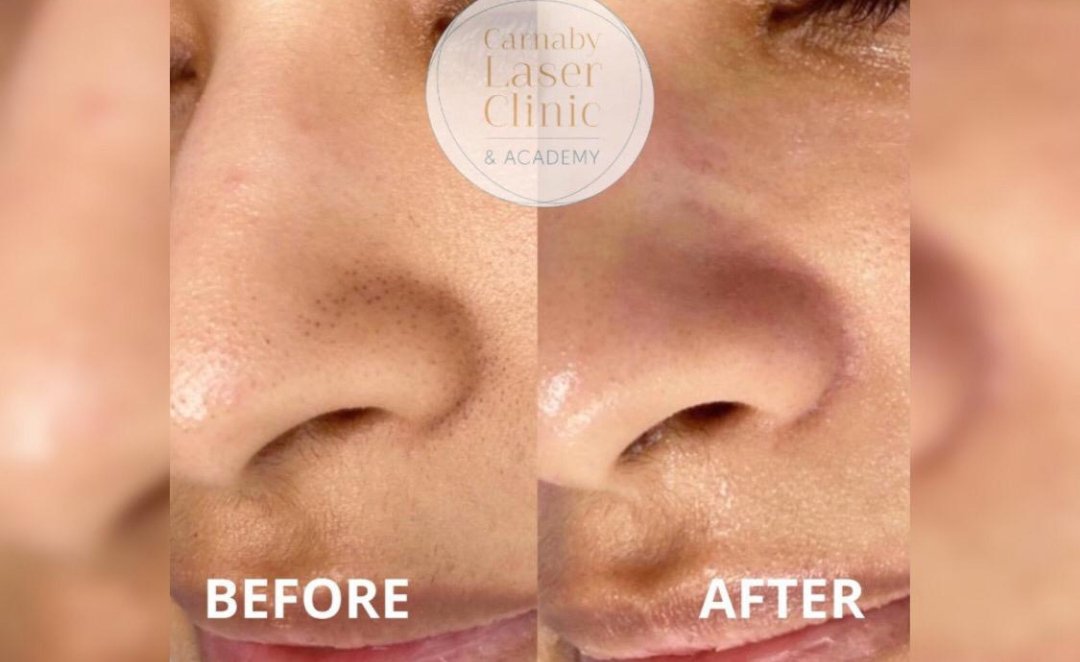 صورة توضيحية - مركز Carnaby Laser Clinic and Academy يُقدم التقنية الأفضل لبشرة نضرة ومتوهجة
