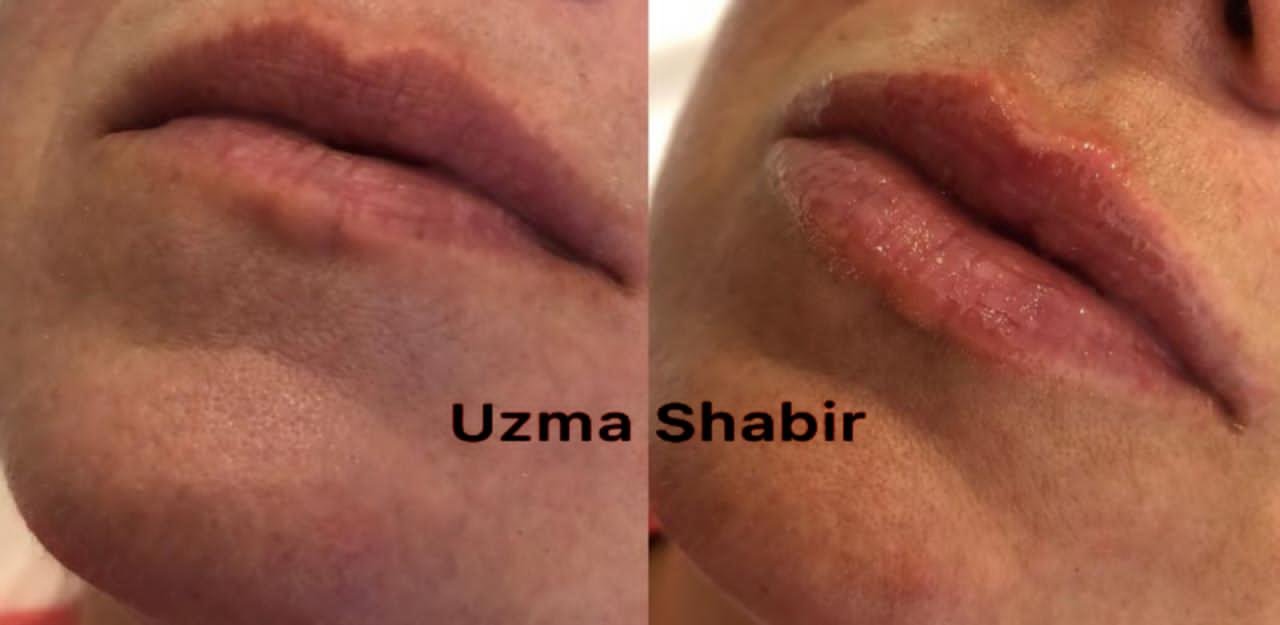 صورة توضيحية - خبيرة التجميل عظمي شبير/ Uzma Shbr خبيرة في مجال حقن الفيلر
