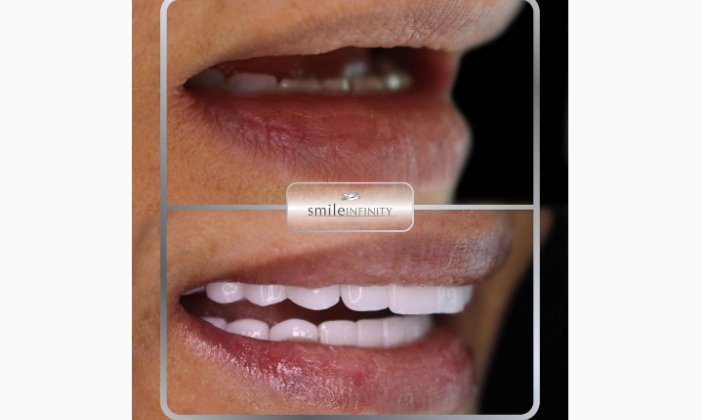 صورة توضيحية - جراح تجميل الأسنان د. حبيب ظريفه يتحدث عن محاسن زراعة الأسنان في يوم واحد