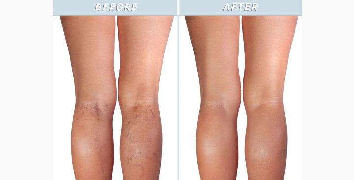 صورة توضيحية - العيادة الطبية التجميلية Carnaby Laser Clinic and Academy تساعد المرضى على التخلص من الأوردة العنكبوتية دون جراحة