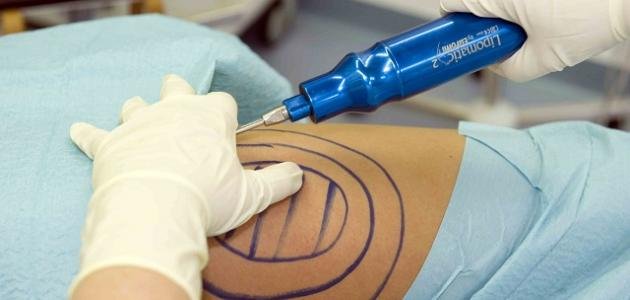 صورة توضيحية - دكتور التجميل اللبناني علي عبد علي يتطرّق الى عملية شفط الدهون