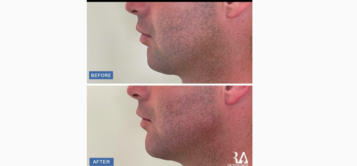 صورة توضيحية - رامي عبادي الرجال يلجأون إلى عمليات التجميل غير الجراحية.