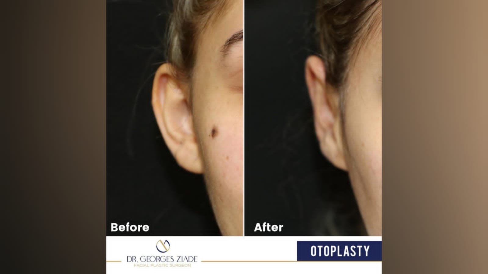 صورة توضيحية - جورج زيادة موضحاً لعملية رأب الأذن/ Otoplasty